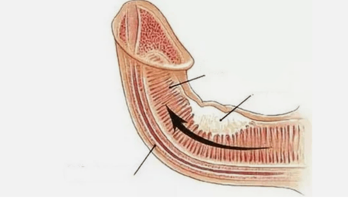 Elimination of the venous drainage